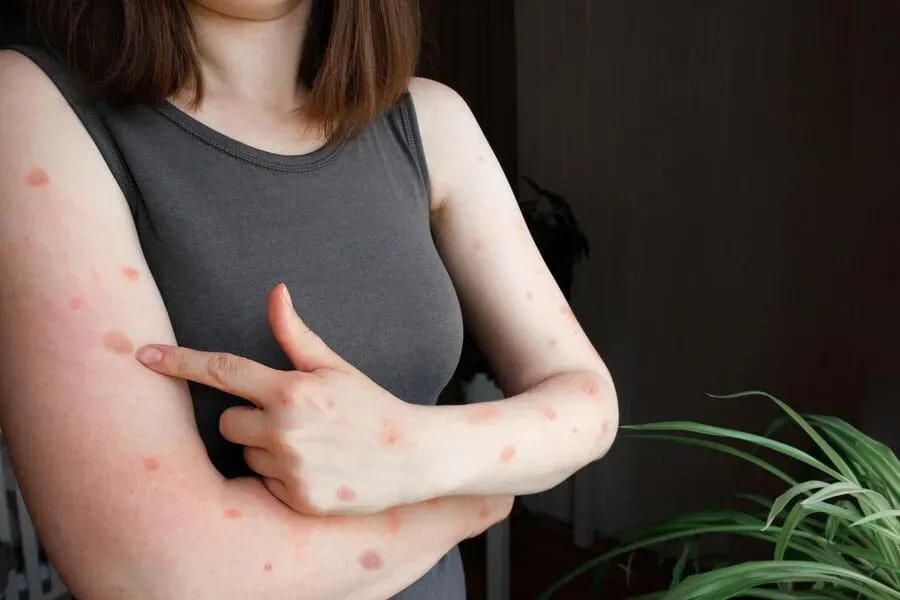 Antibiyotik Alerjisi Nedir?